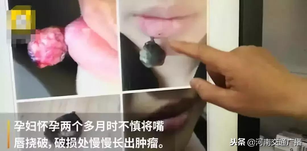 孕妇嘴唇干裂脱皮痛怎么办,孕妇嘴唇干裂脱皮没有口红怎么办