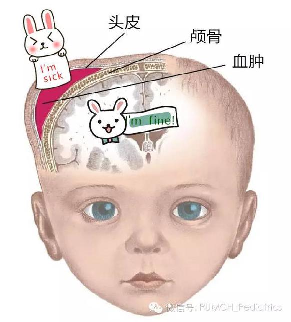 产瘤和血肿的区别ppt,婴儿头皮血肿影像