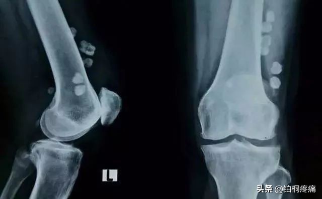 女人膝盖疼痛警惕四种病因,膝盖内侧疼痛的病因