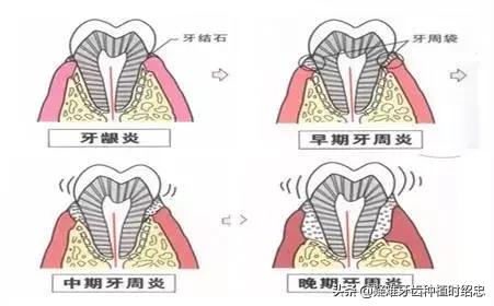 牙周炎导致牙齿松动严重怎么办,重度牙周炎导致牙齿松动