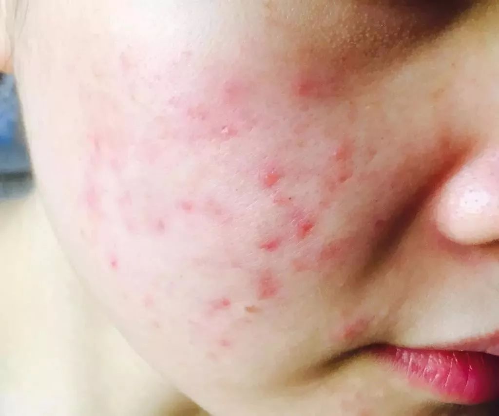 棰濆ご绮夊埡闂彛鎬庝箞鍘婚櫎,鍘婚櫎闂彛绮夊埡鐨勬姢鑲ゅ搧