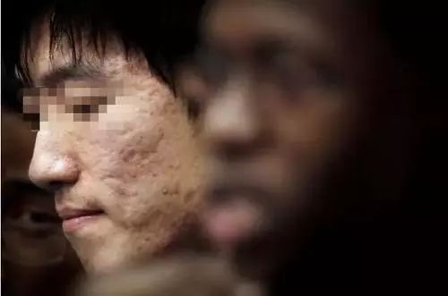 如何处理痘痘留下来的黑印,痘痘留下的痘痕怎么快速消除