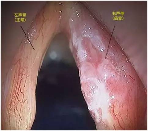 如何知道咽炎还是喉癌,我们如何才能知道自己得了喉癌呢