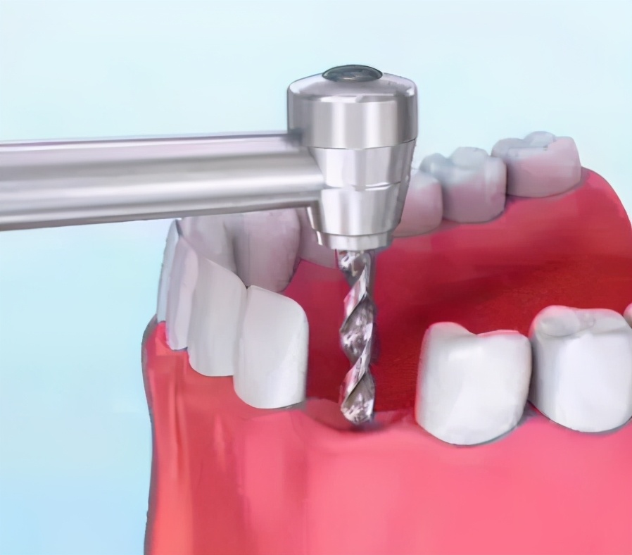 种牙内幕,种植牙的猫腻在什么地方