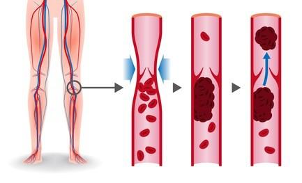 腿疼血栓是什么原因引起的,腿疼可能是血栓的征兆