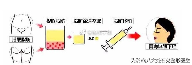 广东中医院自体脂肪填充后缩下巴,下巴自体脂肪填充需要多久