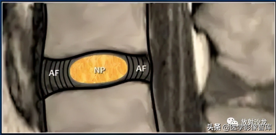 一键收藏所有的内容,颈椎间盘病变的症状和治疗