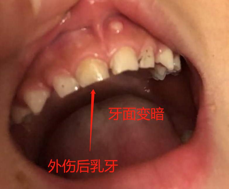 宝宝门牙发黑怎么根管治疗,宝宝门牙变黑是什么原因