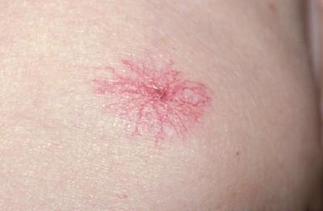 身上出现小红点一定要注意,身上的小红点是什么原因怎么治疗