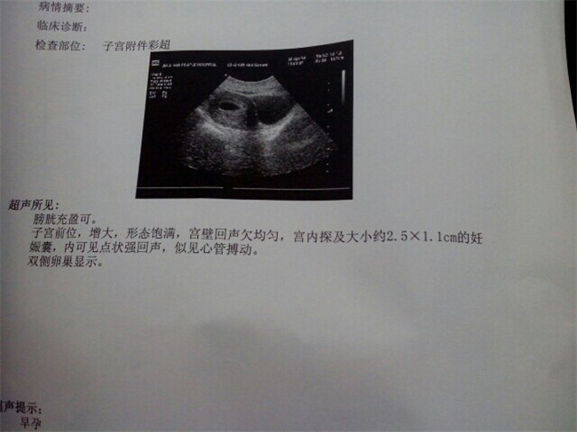 产科医生在孕几周可以听到胎心,怀孕一般几周去照b超有胎心胎芽