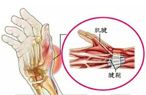 手腕腱鞘囊肿没肿但是痛怎么处理,手腕突然鼓起硬包摸起来不痛