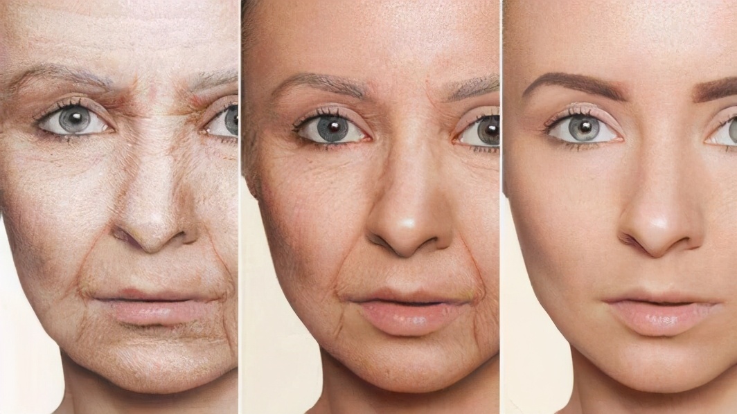 法令纹显老10岁三种方法帮助缓解,法令纹怎么消除4妙招告别衰老