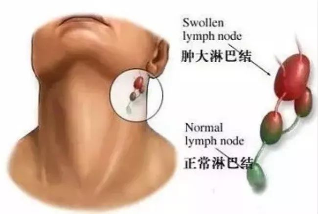 儿科医生刘鉴肠系膜淋巴结,儿科医生刘鉴腹部淋巴结肿大
