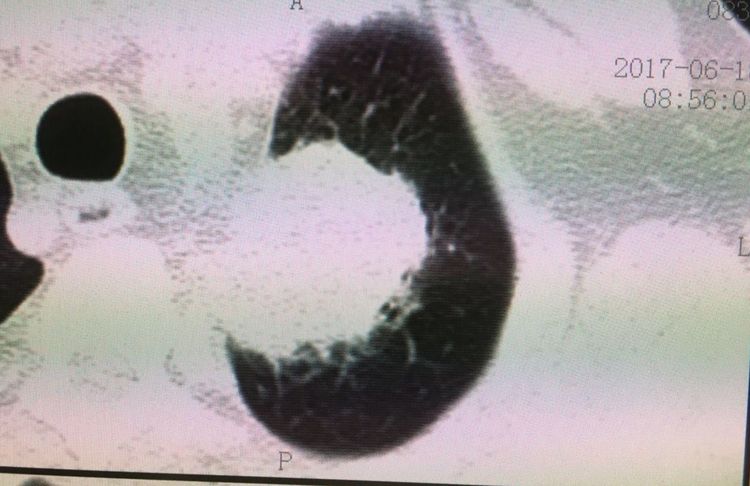 肺癌长期生存或治愈有不同吗,肺癌未治疗活了11年怎么解释