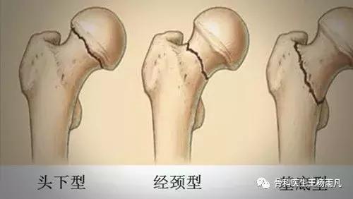 鬼门关前一道坎（上篇）：家里老人滑到了，胯部骨折了严重吗？