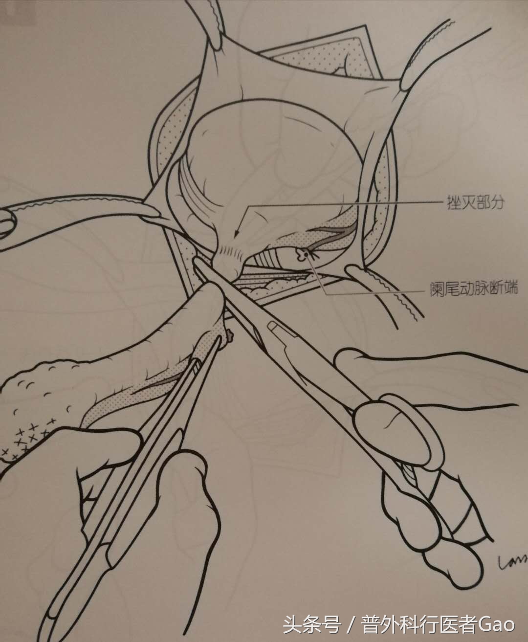 杏仁：一图一话全面解析阑尾的切除过程（干货，不懂医也学习了）