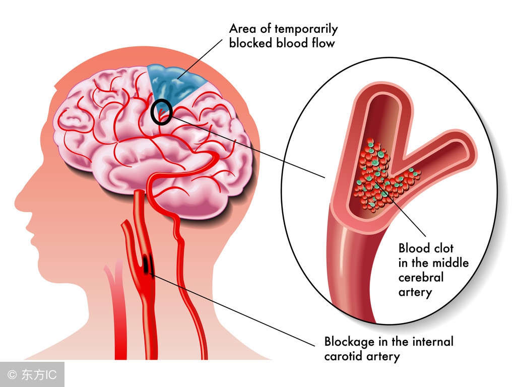 脑堵塞和脑出血哪个严重,脑溢血和脑血栓症状有什么区别