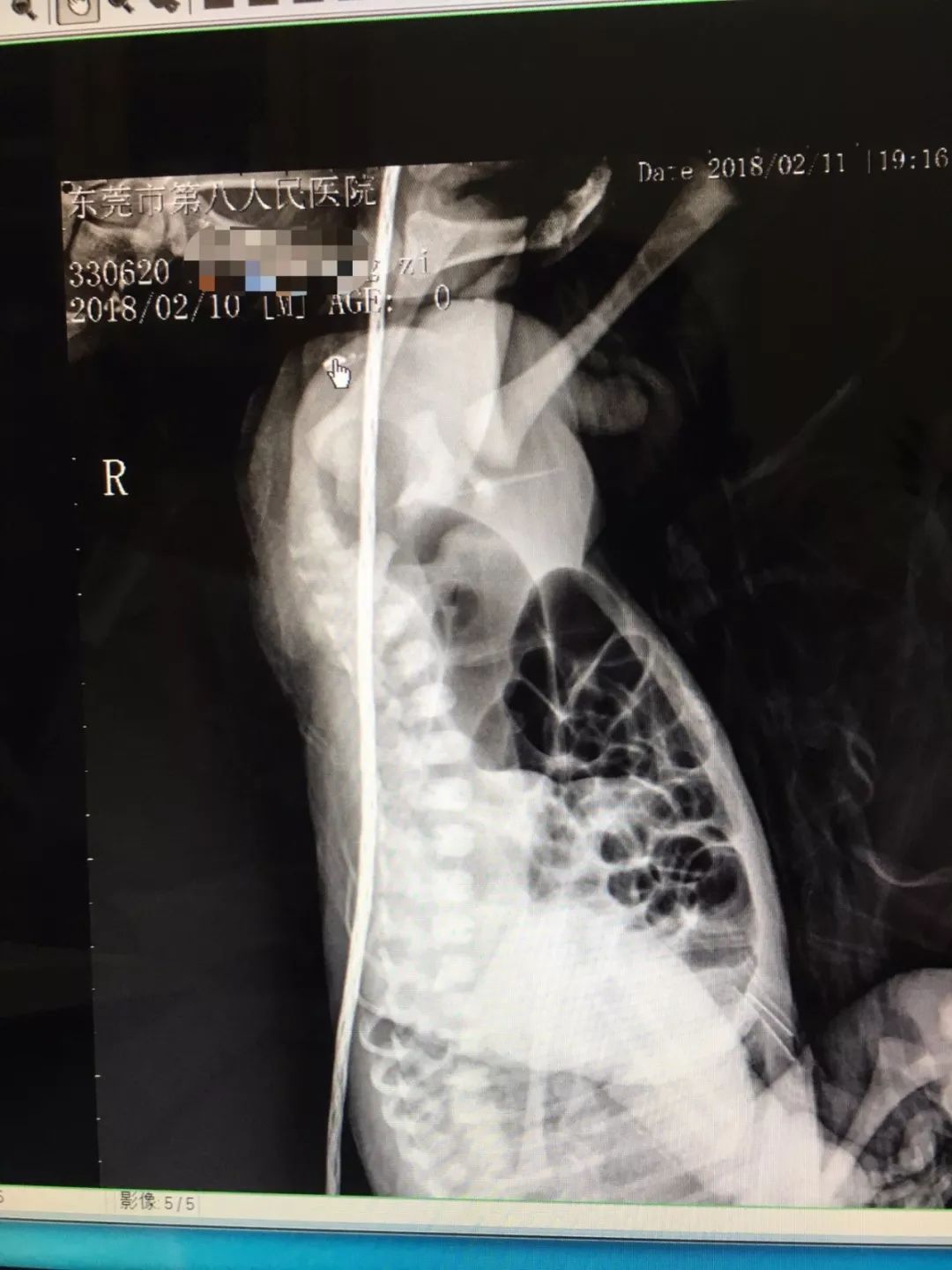 东莞男婴生下来没有肛门!愁坏了父母,憋坏了孩子……医生……