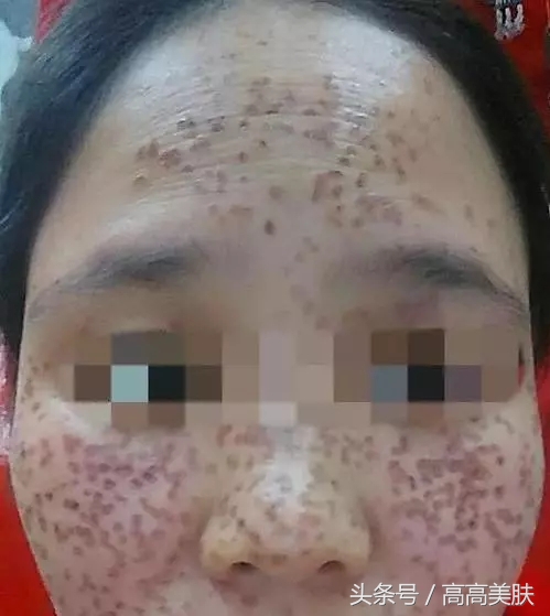 祛斑最有效方法辟谣,十大坑人的网红祛斑产品