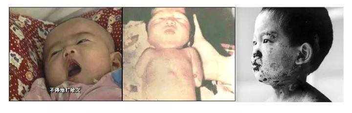 吸毒怀孕生下的孩子,爸妈吸毒生下的婴儿是什么的症状