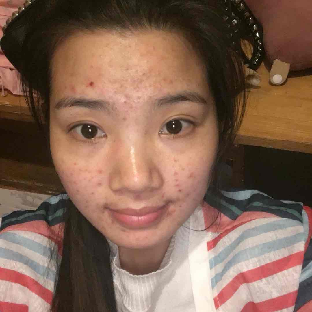 痘印变黑一直不消怎么办,痘印变黑后怎么消除