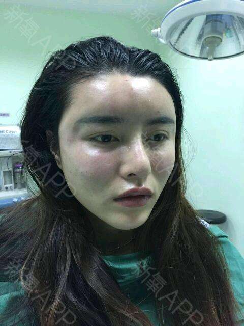 自体脂肪脸部填充能有提升效果吗,自体脂肪填充脸注意事项