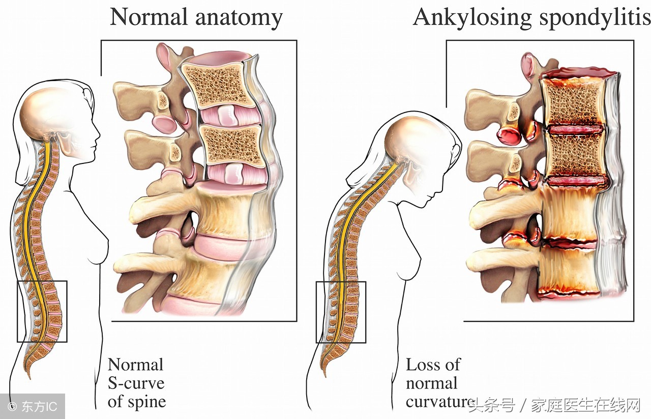 16周岁经常腰部酸痛,20几岁的年轻人腰痛是怎么回事