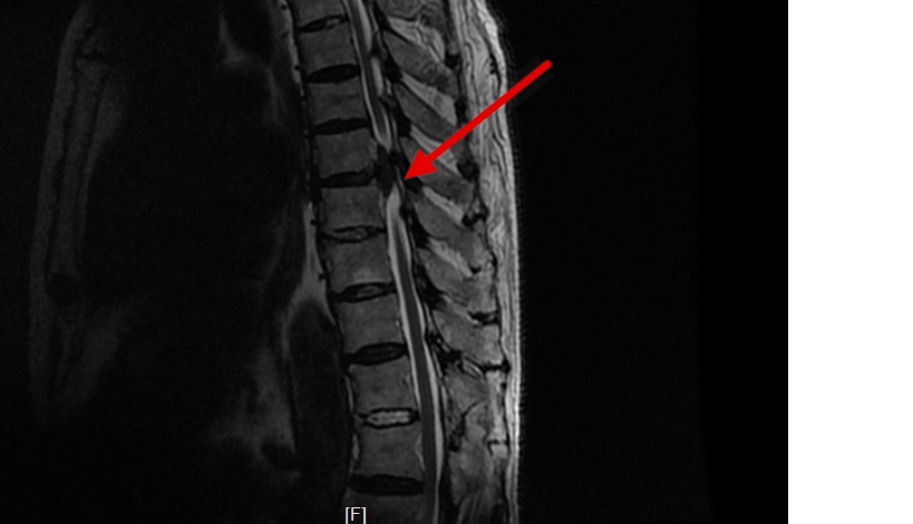 什么叫微创脊柱内镜手术,全可视脊柱内镜技术