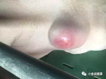 脓包型痤疮怎么治疗,脓包的最佳治疗方法