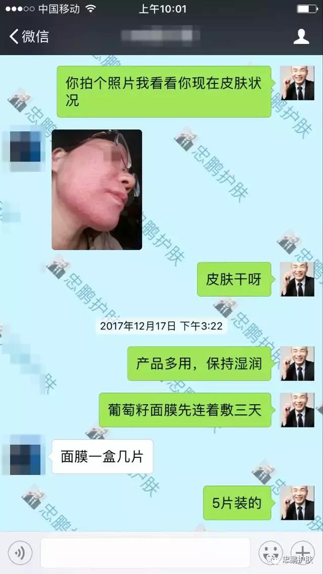 激素脸发红发热脱皮怎么办呢,激素脸为什么会扩散到脖子上代谢