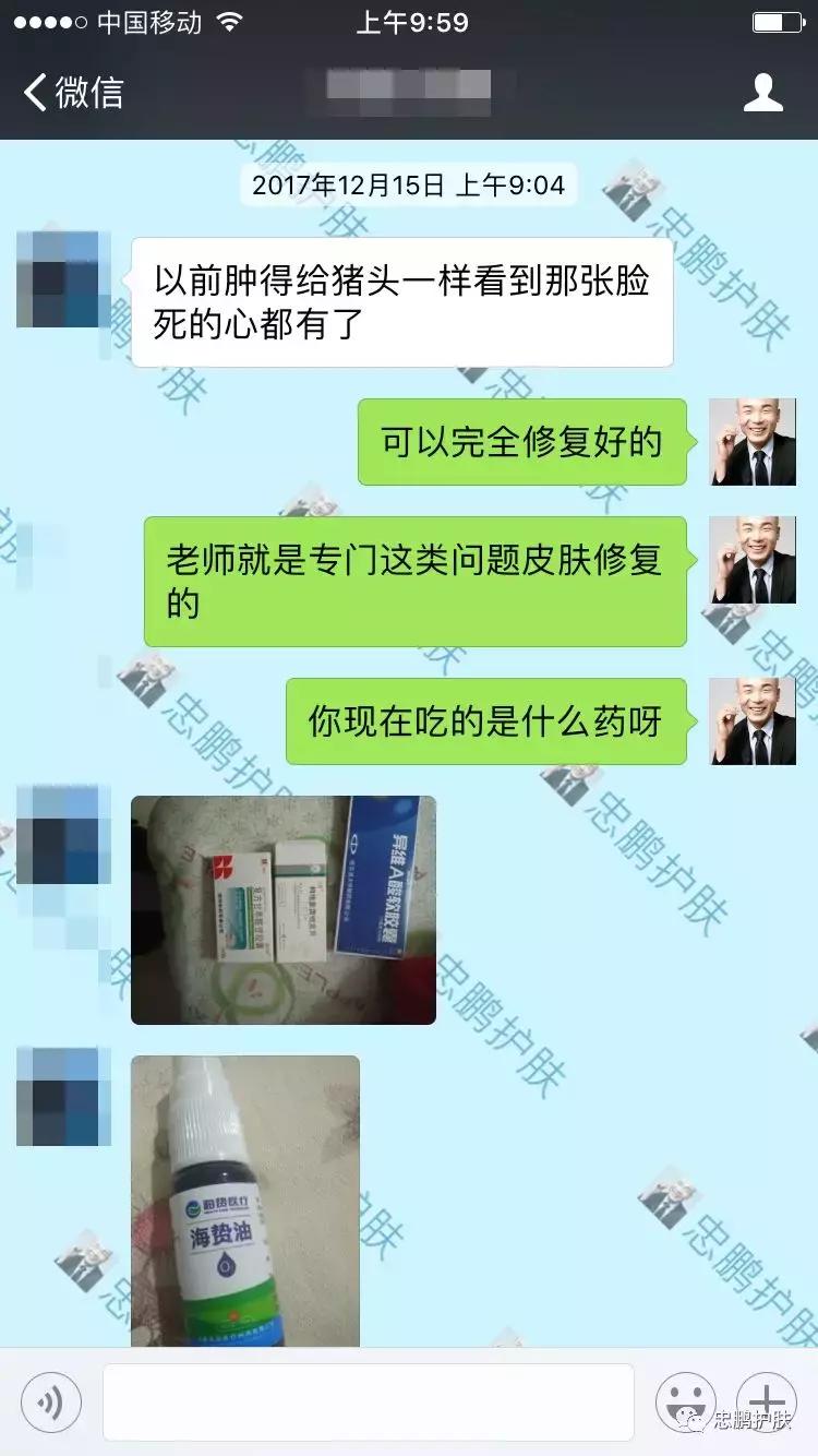 激素脸发红发热脱皮怎么办呢,激素脸为什么会扩散到脖子上代谢