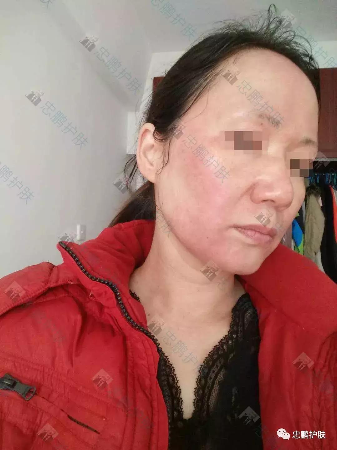 激素脸发红发热脱皮怎么办呢,激素脸为什么会扩散到脖子上代谢