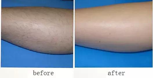 1秒脱毛,如何在一分钟内脱毛