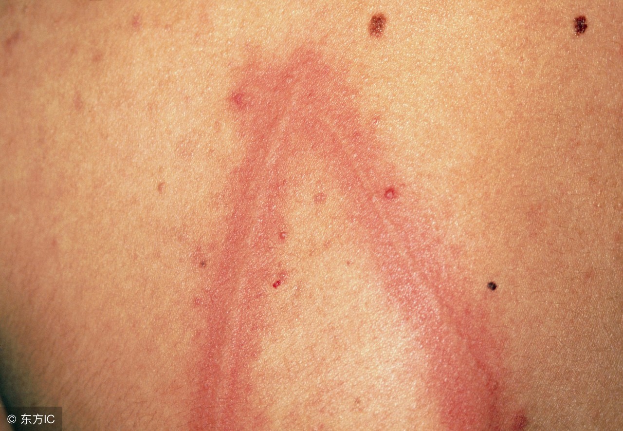 荨麻疹患者特别需要注意哪些饮食,患有荨麻疹时在饮食上应注意哪些