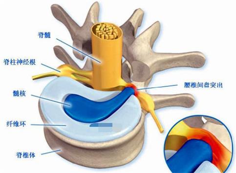 阳痿，可能是腰椎间盘突出惹的祸！
