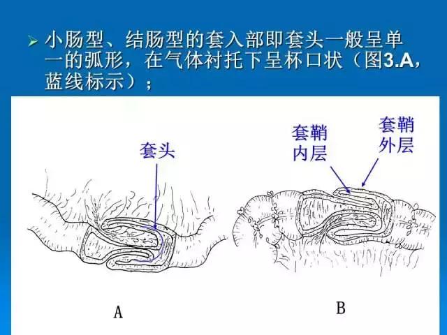 儿童肠套叠空气灌肠后遗症,儿童肠套叠空气灌肠复发几率高吗