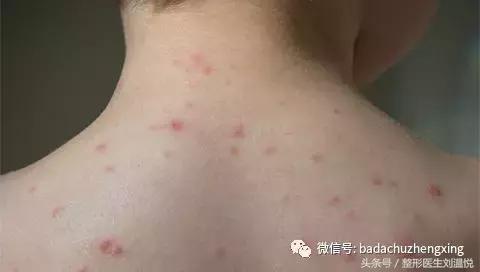 孕期长红疹水痘,孕期得了水痘怎么治疗