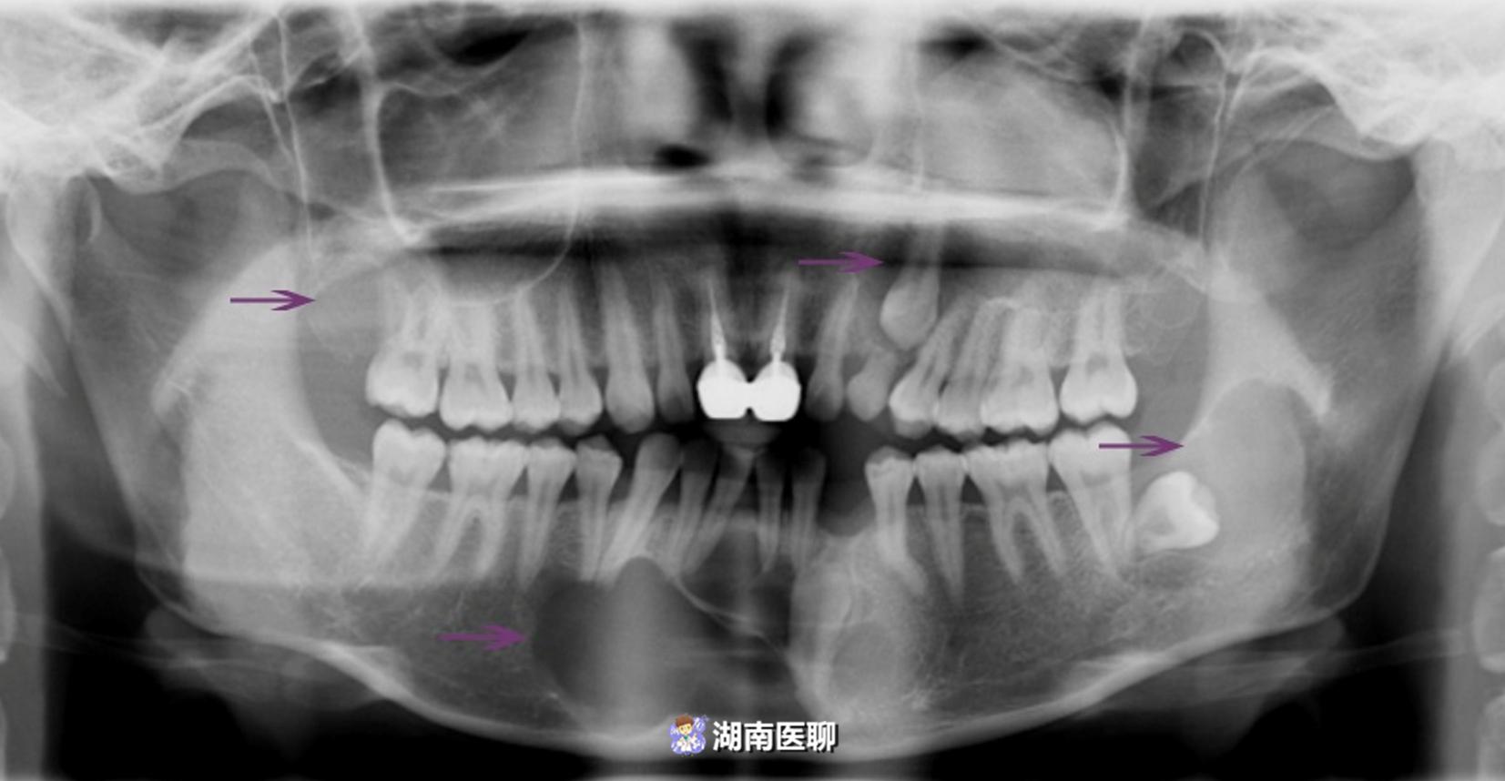 口腔黏膜很多白点和创伤,口腔黏膜肿了为什么不痛