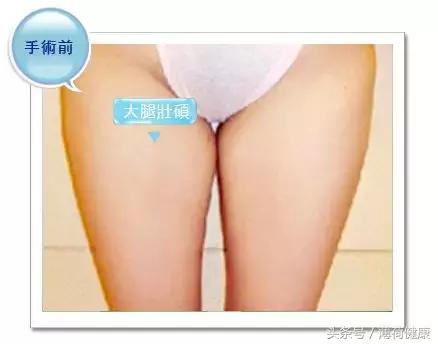 女性大腿内侧肉松弛怎么锻炼,腰和左大腿内侧肉疼什么原因