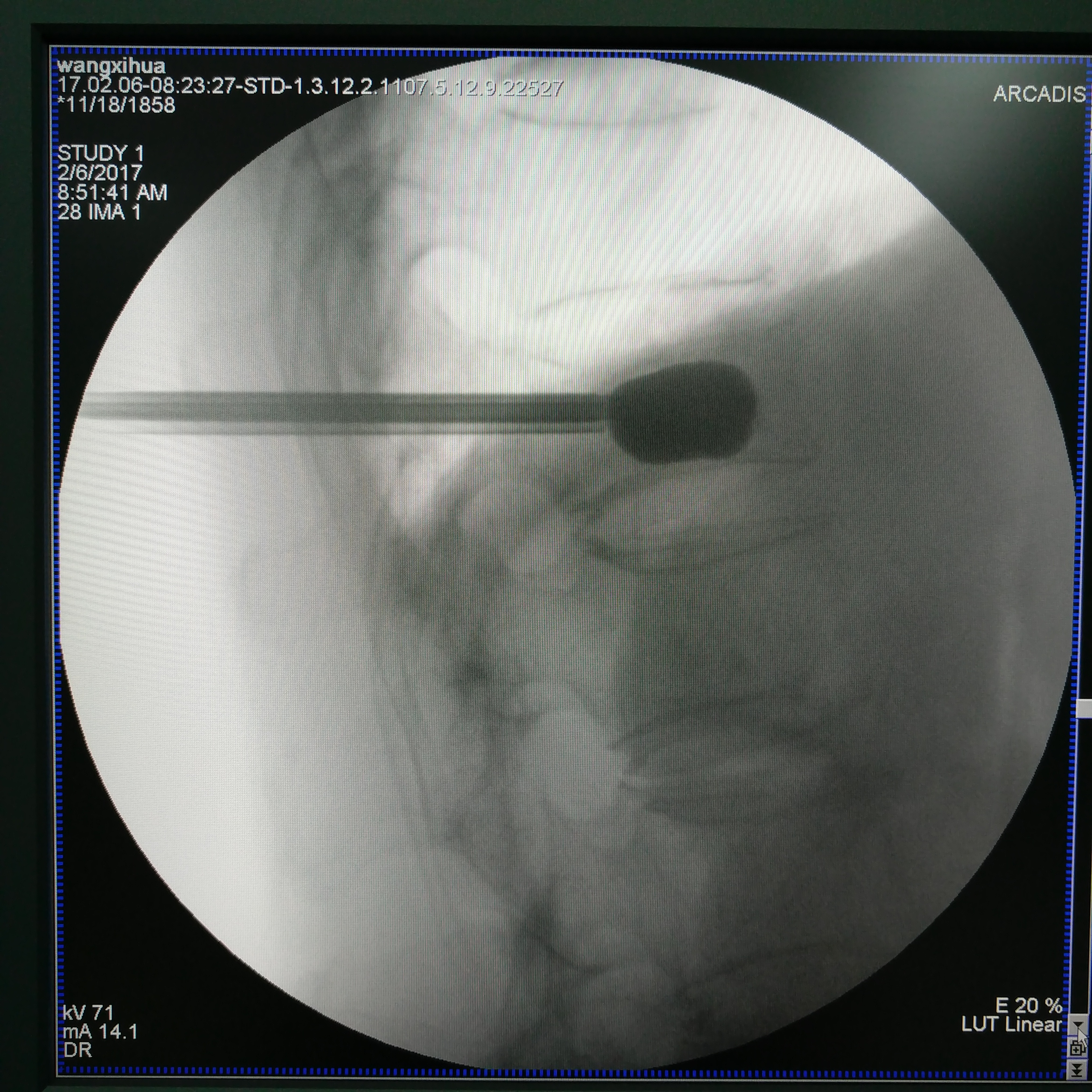 骨质疏松脊柱压缩性骨折怎么治疗,脊柱及四肢骨折的治疗决策
