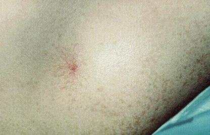 肝癌发生前几个明显信号要注意,肝癌早期症状隐藏五类人群需警惕