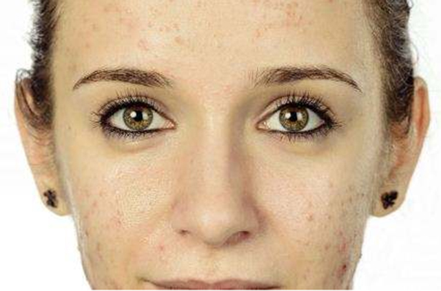 快速祛痘印小窍门真的管用,教你几招祛痘印的最快方法