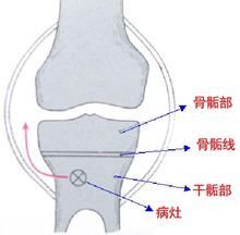 儿童骨骺受损后果严重吗,儿童损伤导致骨骺线闭合