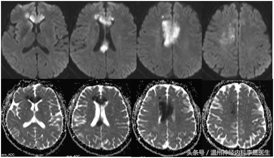 张景明教授讲脑中风后遗症,李医生讲中风视频全集