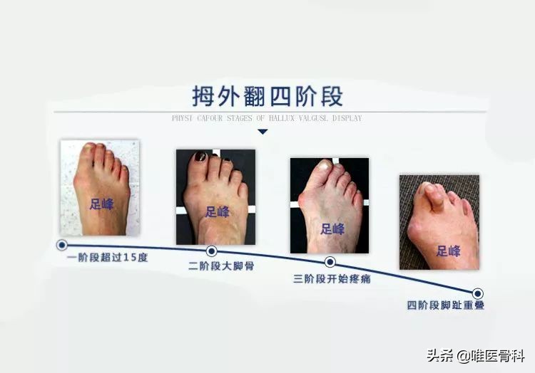 詹姆斯的脚趾发肿,詹姆斯的脚趾是拇外翻吗