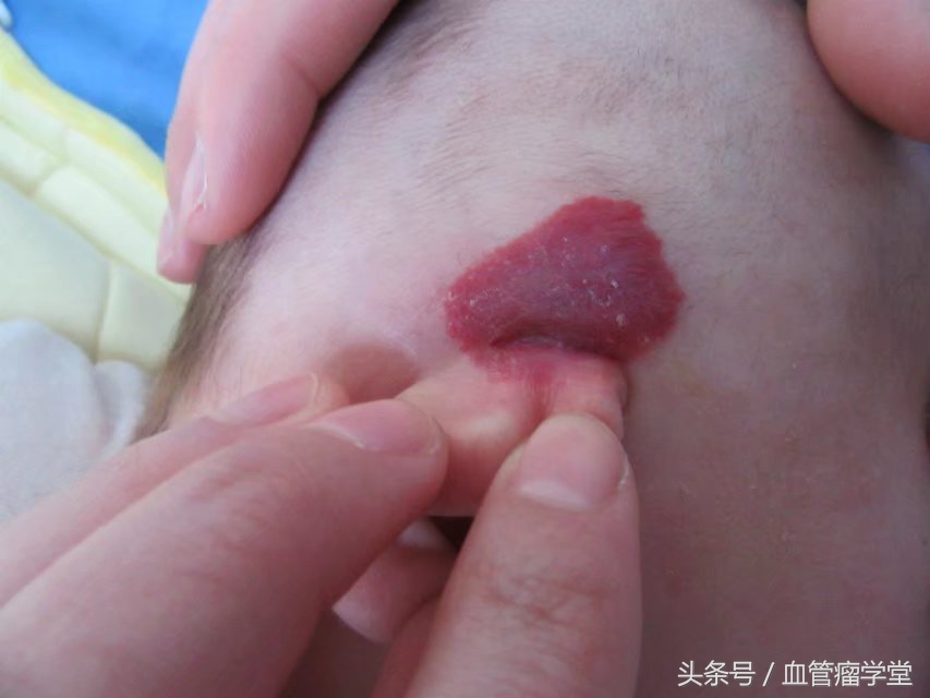 皮肤血管瘤治疗方法和优缺点,儿童激光治疗血管瘤优缺点