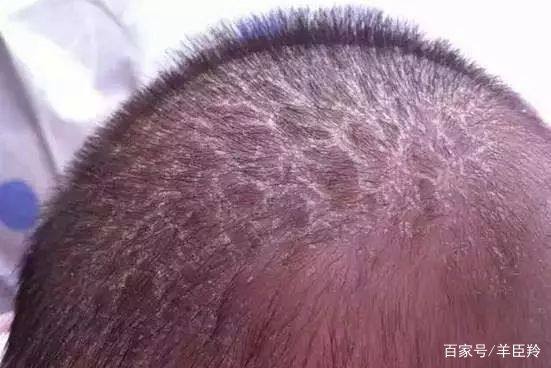 口水疹尿布疹特效药,宝宝水痘怎么护理