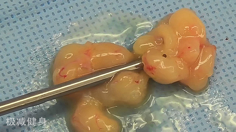 抽脂减肥的过程与效果,抽脂减肥的过程和效果