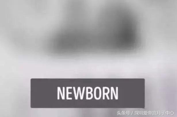 宝宝出生高度近视,婴儿出生是远视还是近视