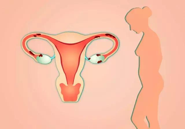 子宫切除后还能过上正常生活吗,子宫切除后还能得癌症吗